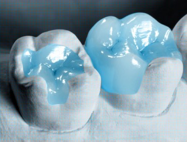 Dental-Inlays-Onlays